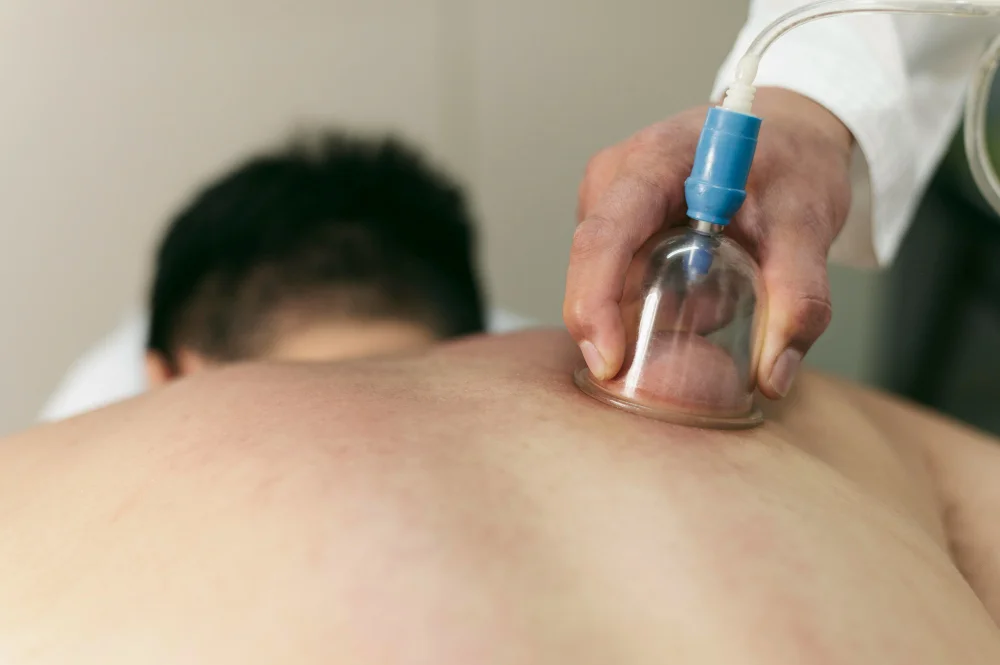 Cupping Therapy